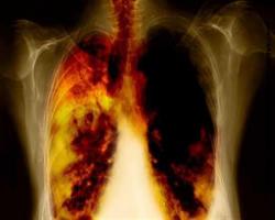 Hastanelerin yarısı Akciğer kanseri vakasıyla dolu