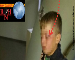 Polis terörü;   8 yaşındaki çocuğu gözünden vurdu